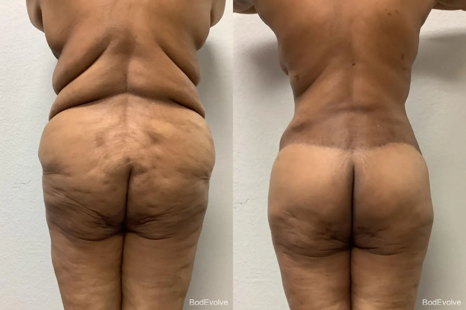 Body Lift: Patient 6 - Before and After 6