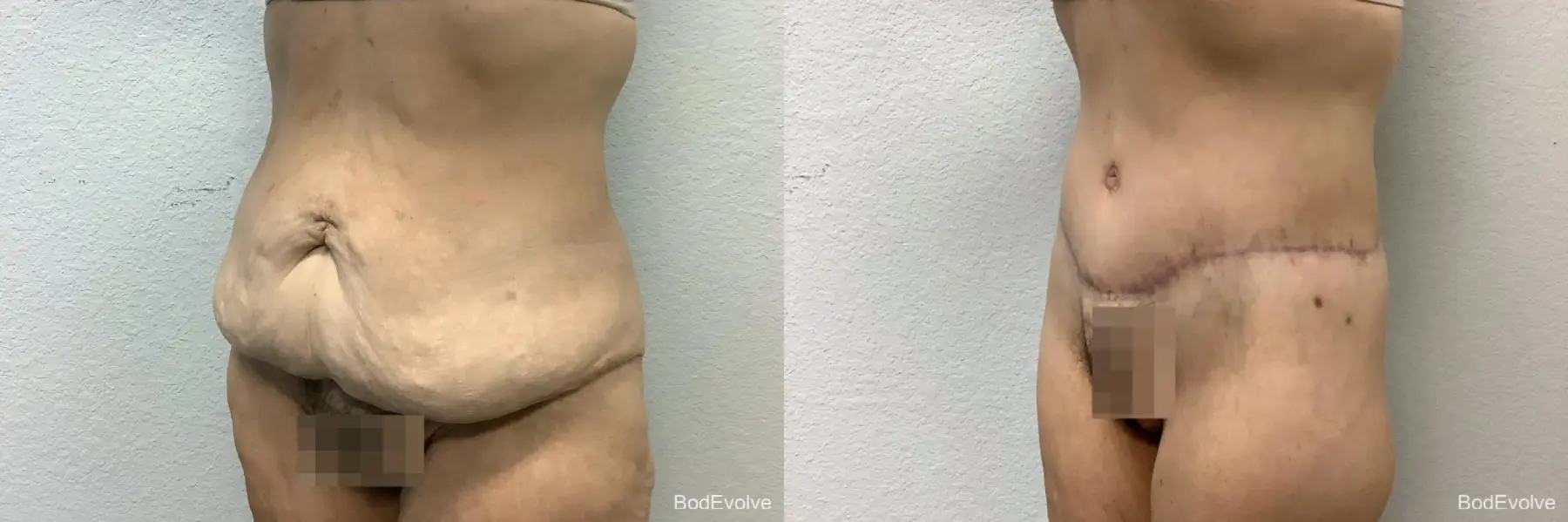 Body Lift: Patient 2 - Before and After 2
