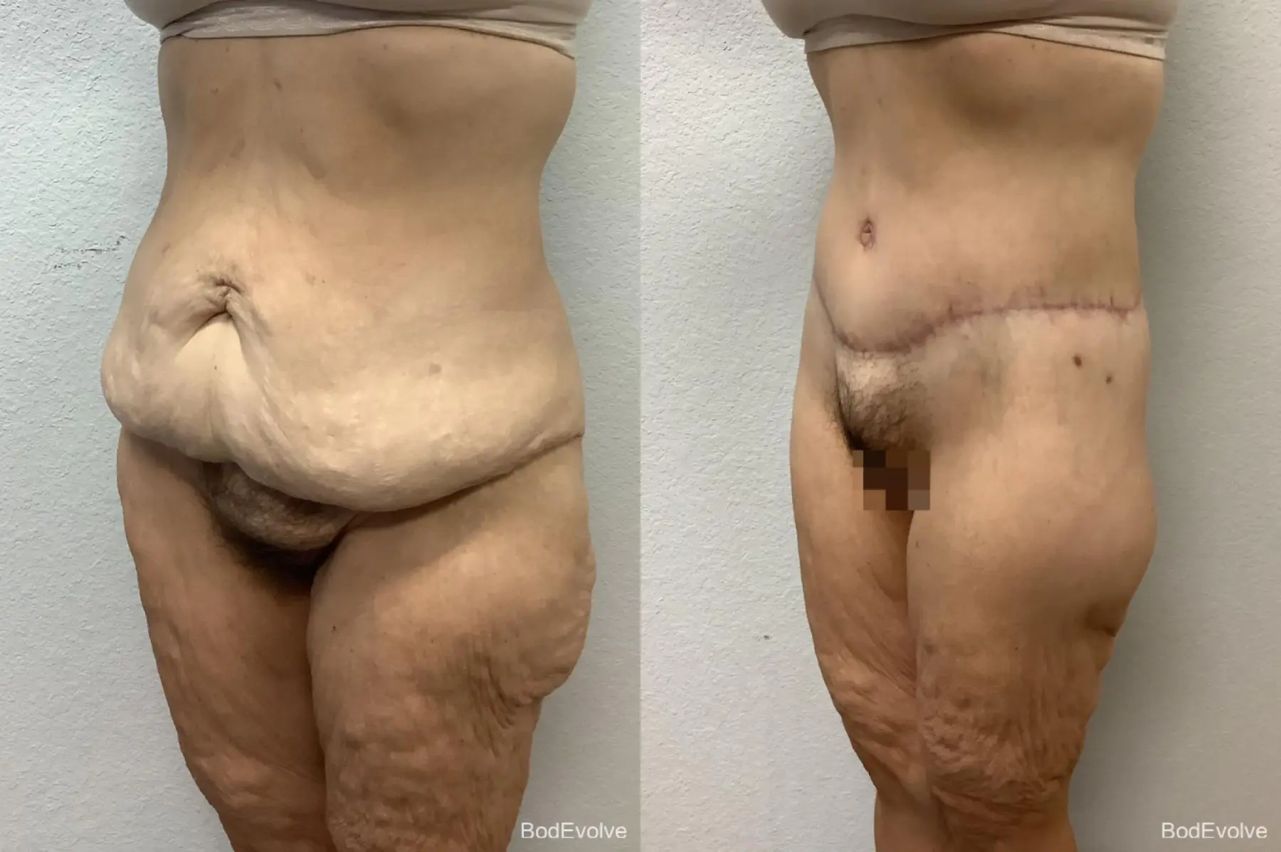 Body Lift: Patient 5 - Before and After 2