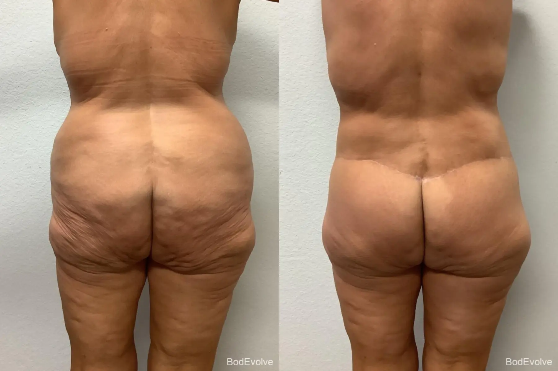 Body Lift: Patient 1 - Before and After 4