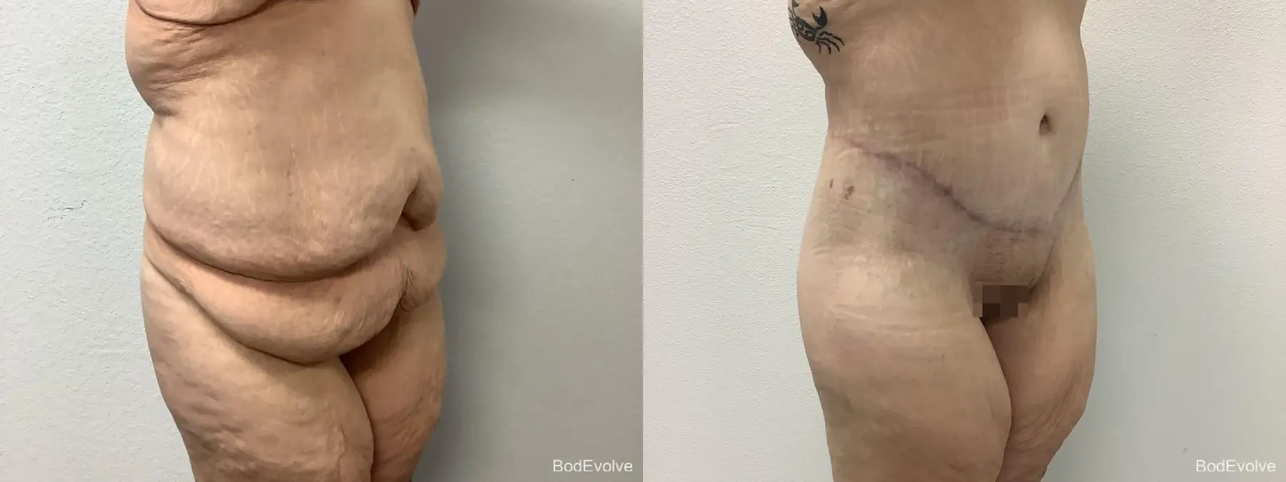 Body Lift: Patient 8 - Before and After 4