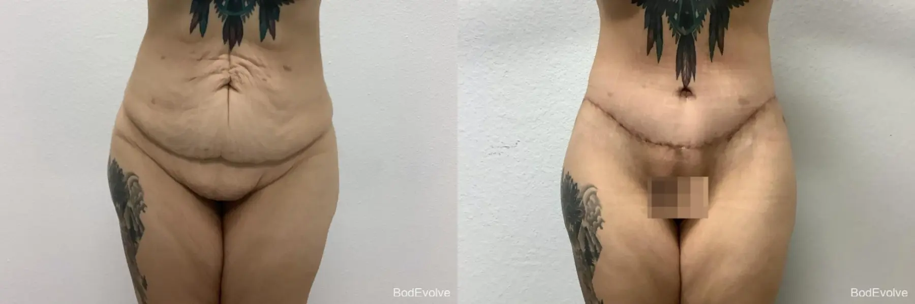 Body Lift: Patient 7 - Before and After 1