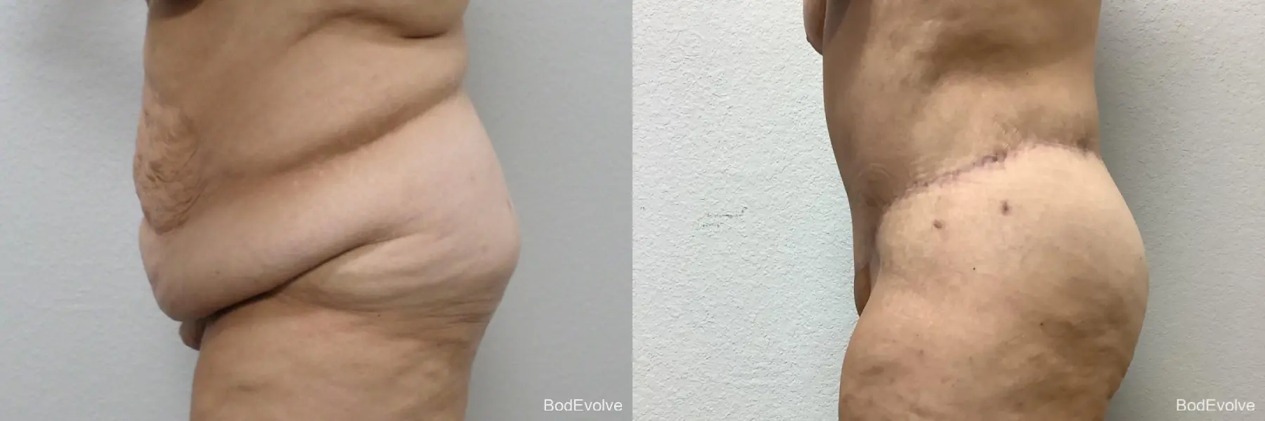 Body Lift: Patient 4 - Before and After 2