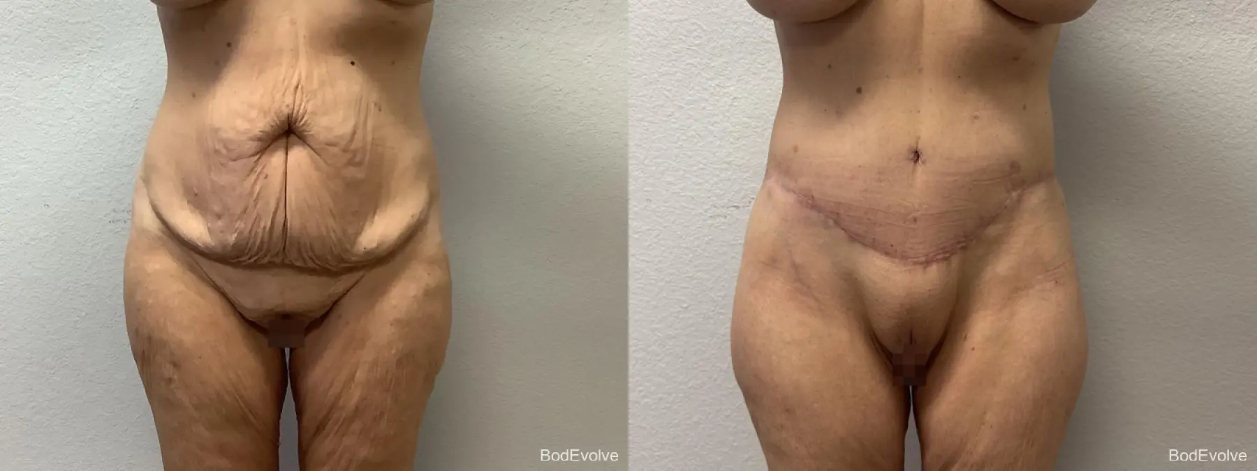 Body Lift: Patient 5 - Before and After  