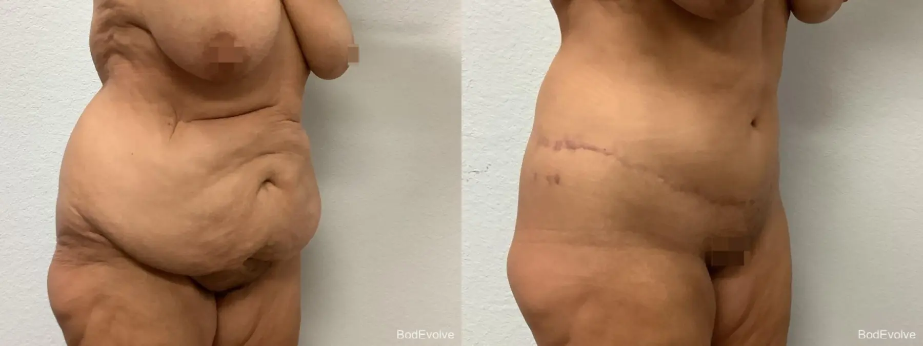 Body Lift: Patient 1 - Before and After 2