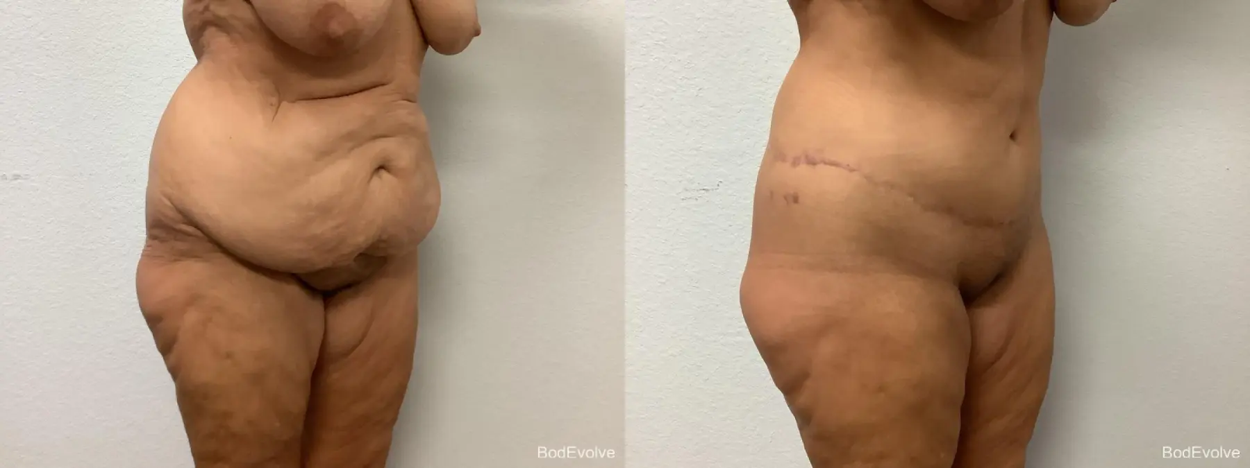 Body Lift: Patient 4 - Before and After 2