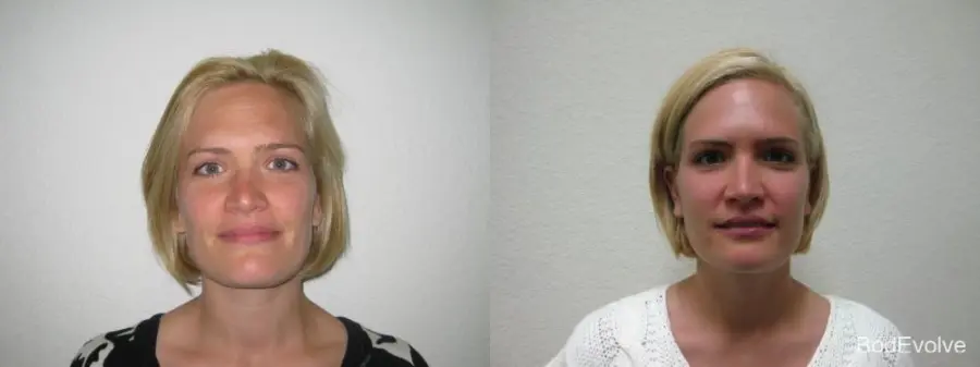 Botox - Patient 1 - Before and After