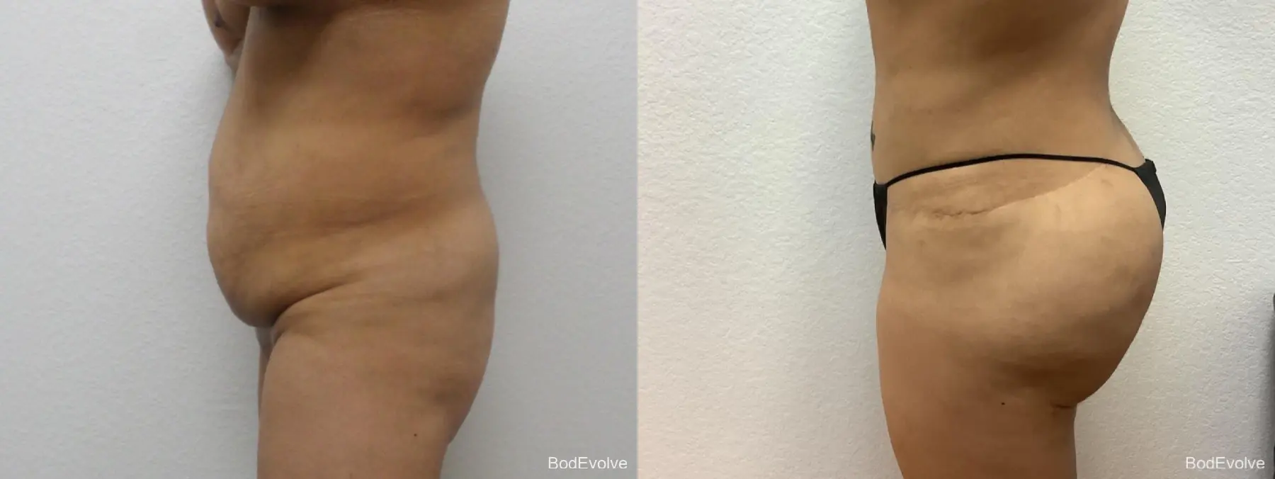 Brazilian Butt Lift: Patient 4 - Before and After 3