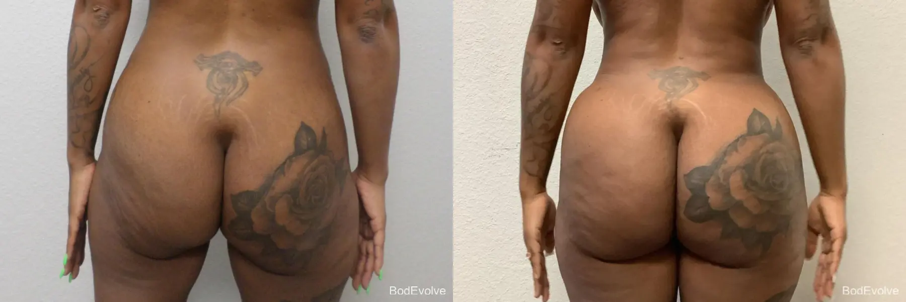 Brazilian Butt Lift: Patient 1 - Before and After 4