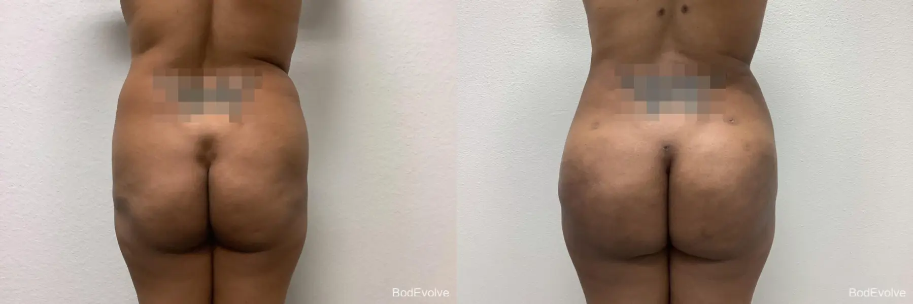 Brazilian Butt Lift: Patient 3 - Before and After 4