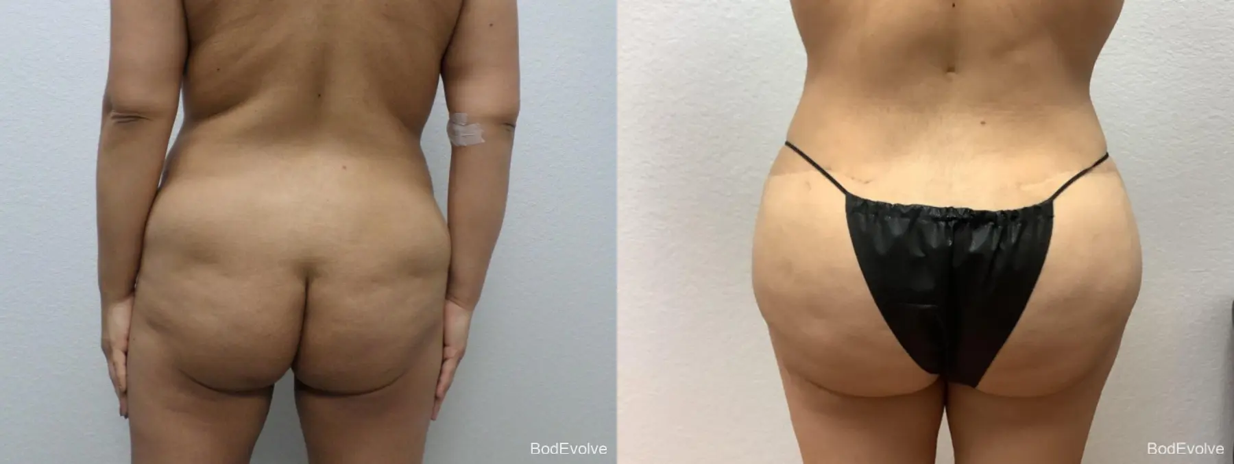 Brazilian Butt Lift: Patient 4 - Before and After 4