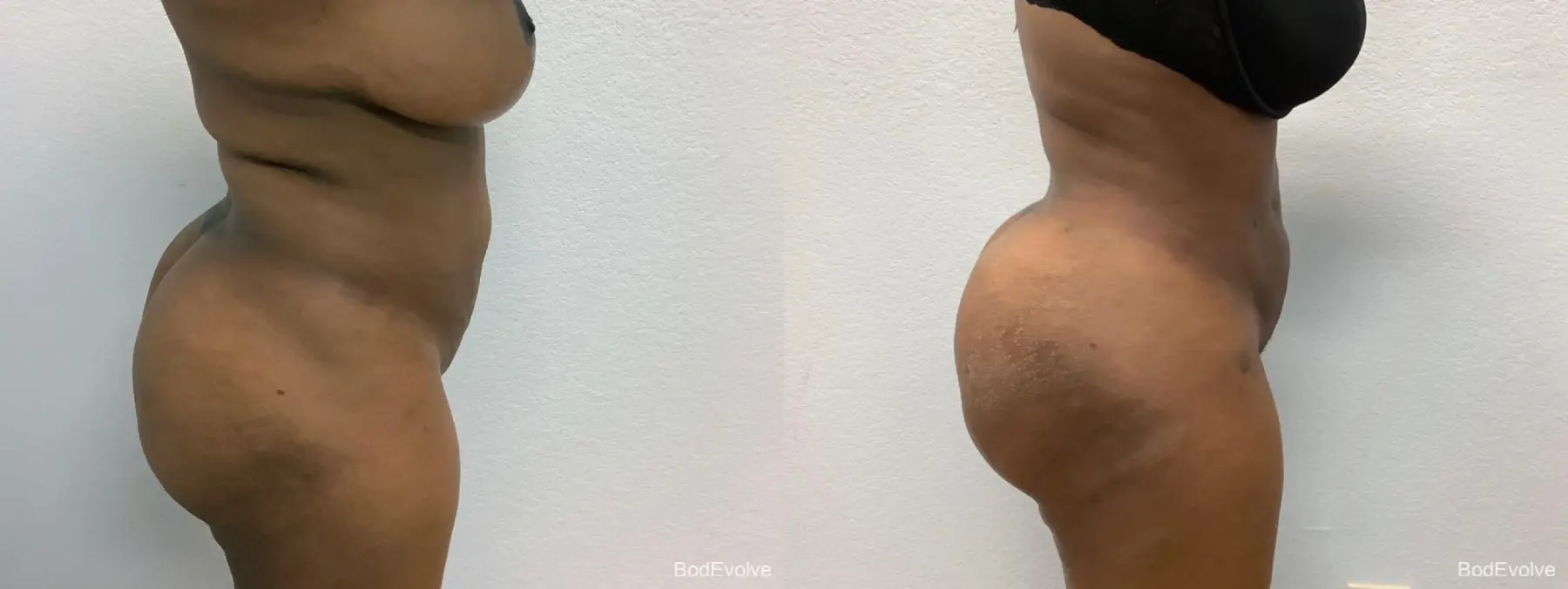 Brazilian Butt Lift: Patient 2 - Before and After 2