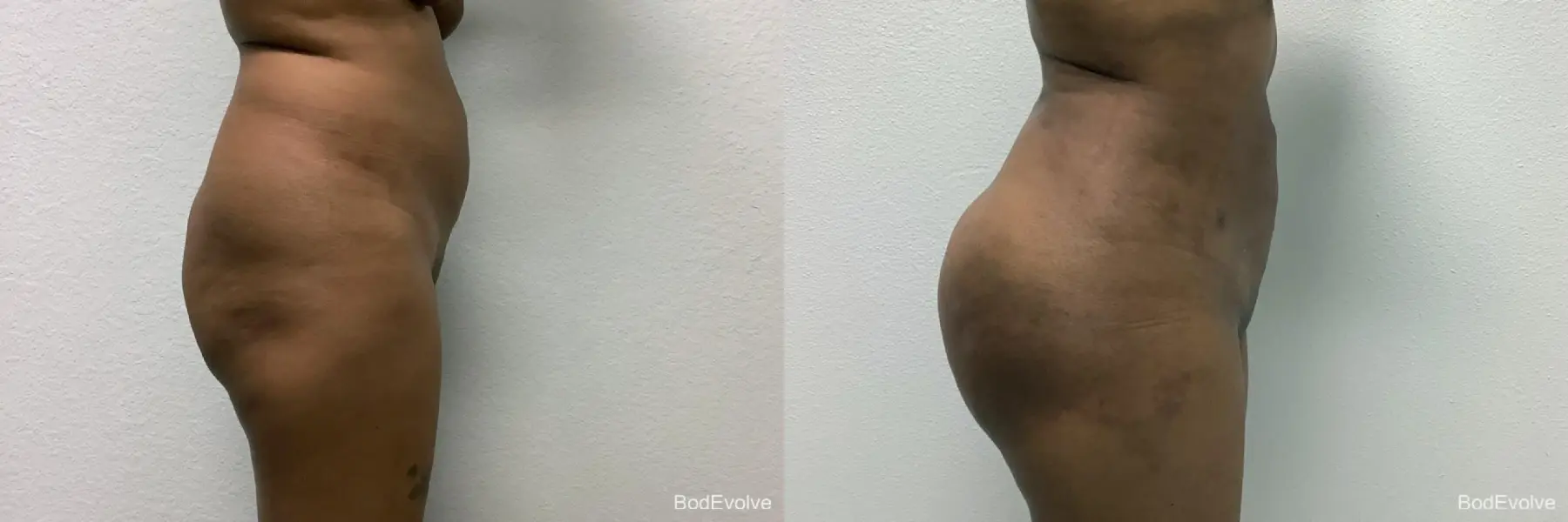 Brazilian Butt Lift: Patient 3 - Before and After 3