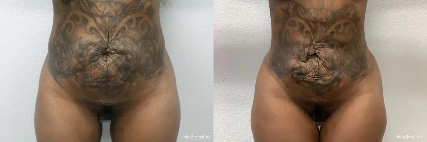 Brazilian Butt Lift: Patient 1 - Before and After 1