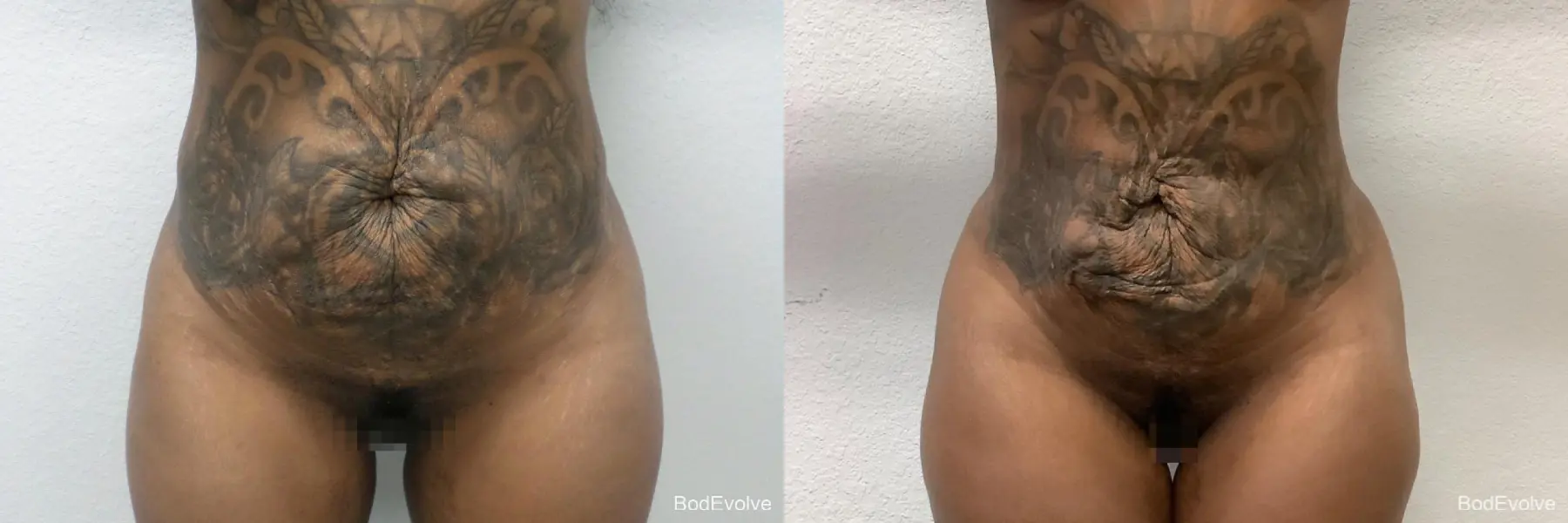 Brazilian Butt Lift: Patient 1 - Before and After  