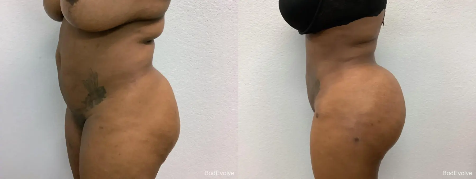 Brazilian Butt Lift: Patient 2 - Before and After 3