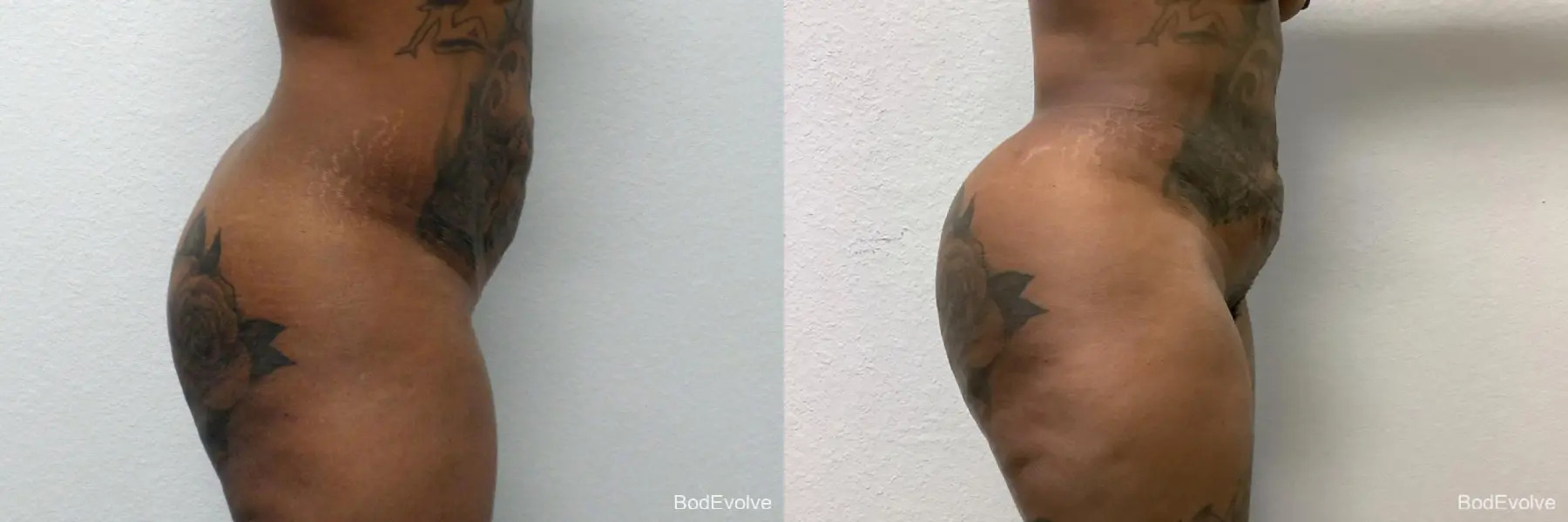 Brazilian Butt Lift: Patient 1 - Before and After 3