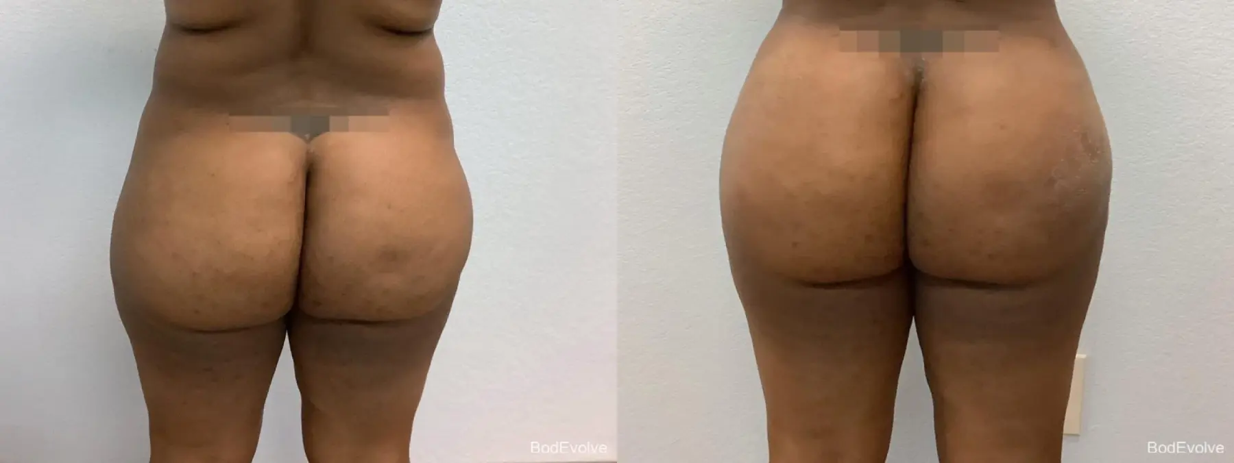 Brazilian Butt Lift: Patient 2 - Before and After 4