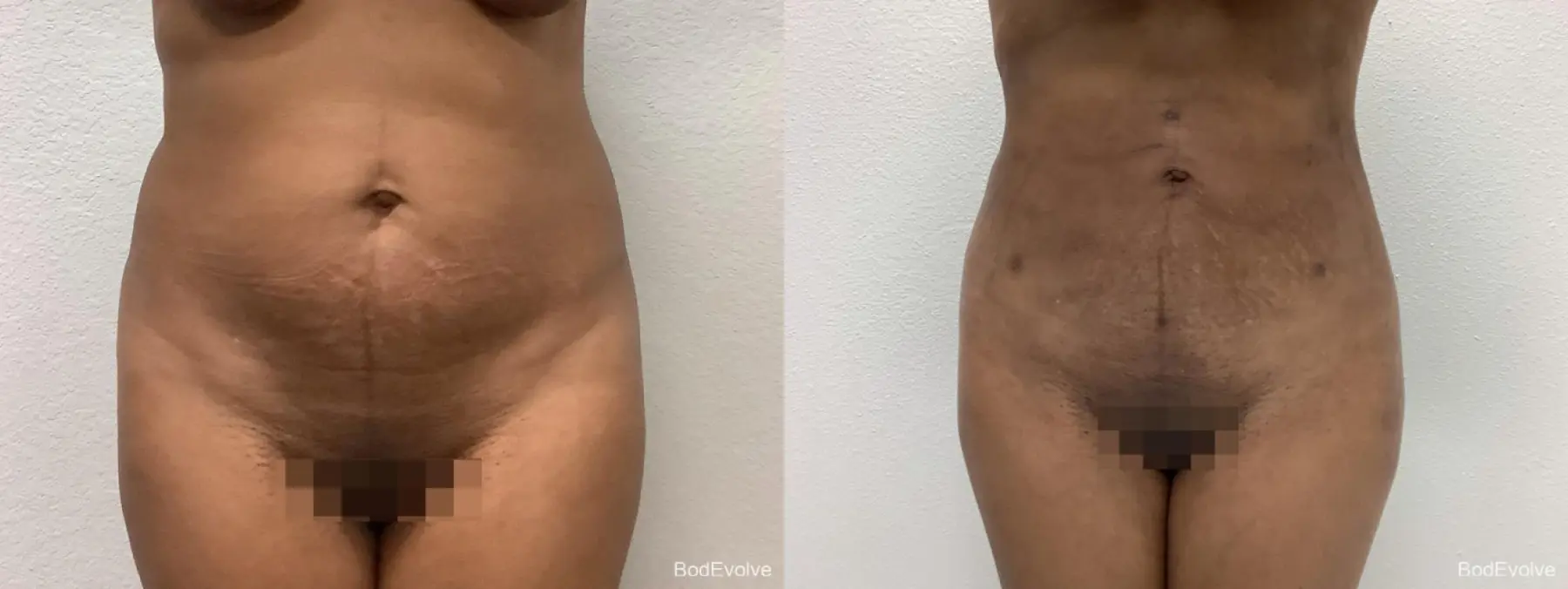 Brazilian Butt Lift: Patient 3 - Before and After 1