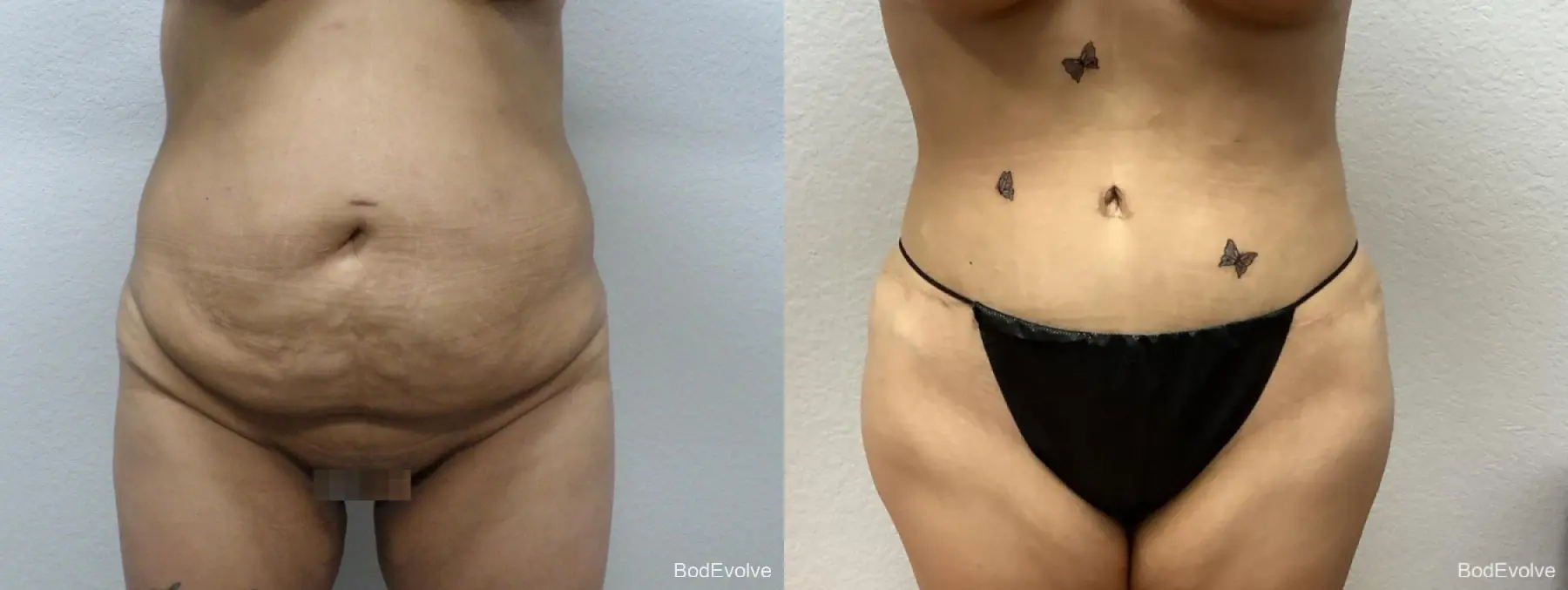 Brazilian Butt Lift: Patient 4 - Before and After  