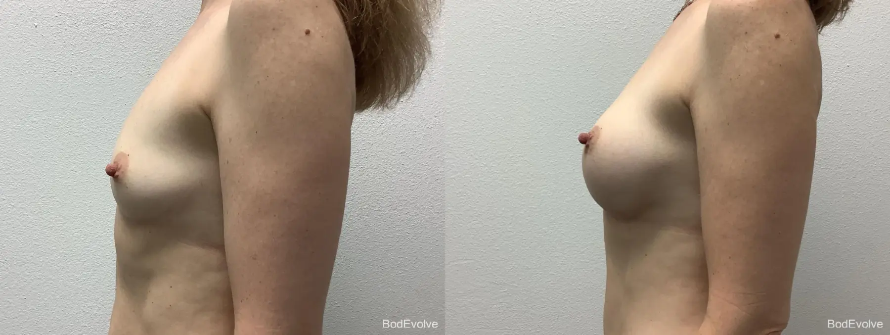 Breast Augmentation: Patient 7 - Before and After 3