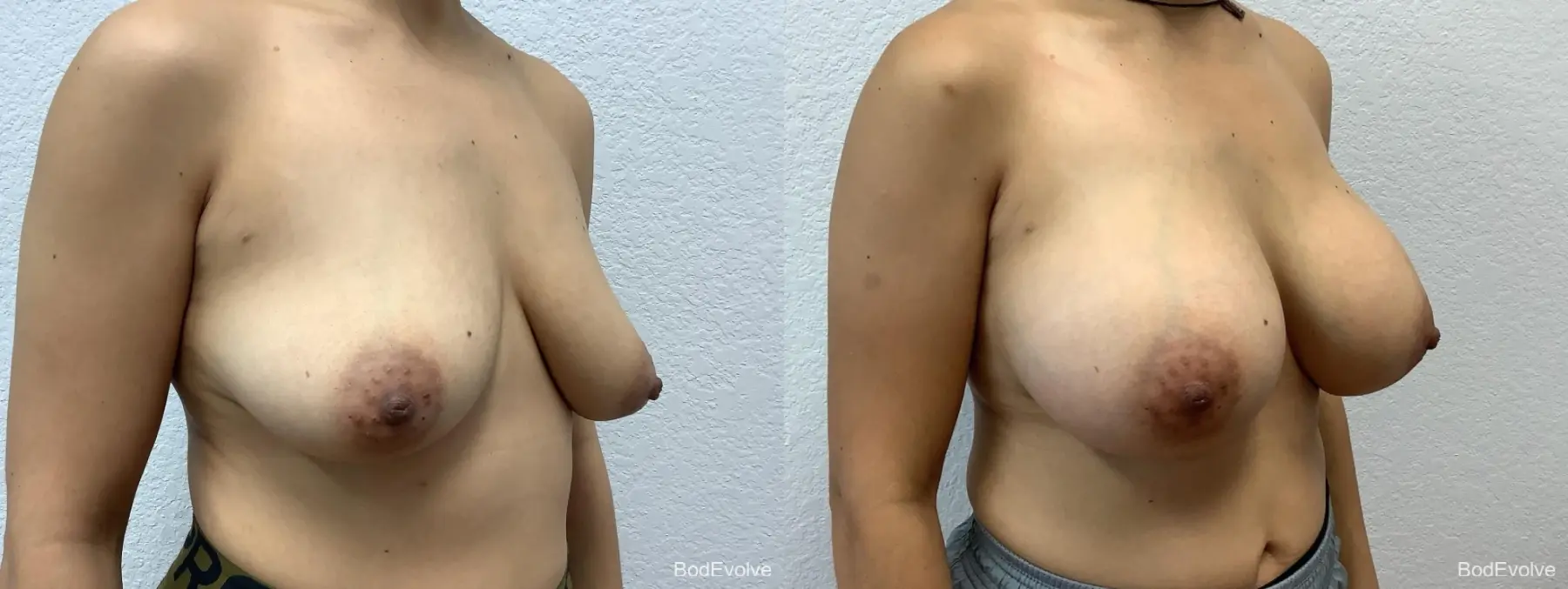 Breast Augmentation: Patient 5 - Before and After 4