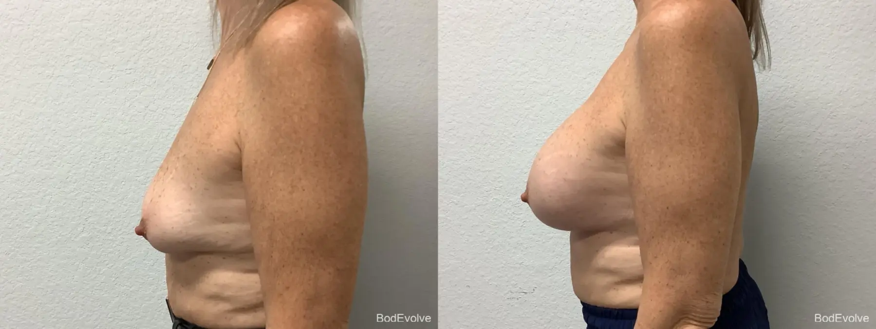 Breast Augmentation: Patient 9 - Before and After 3