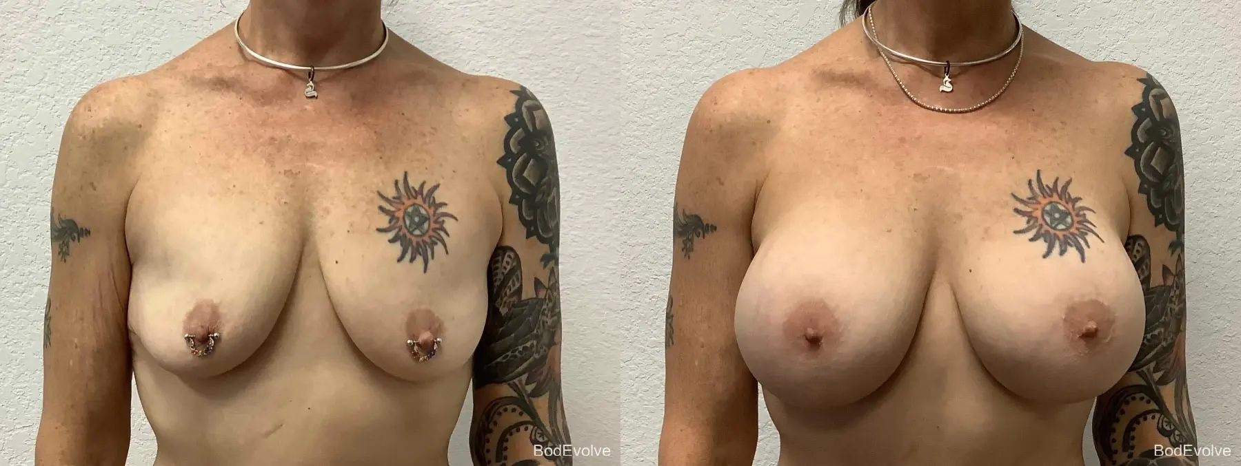 Breast Augmentation: Patient 3 - Before and After  