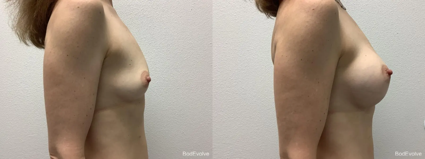 Breast Augmentation: Patient 7 - Before and After 5