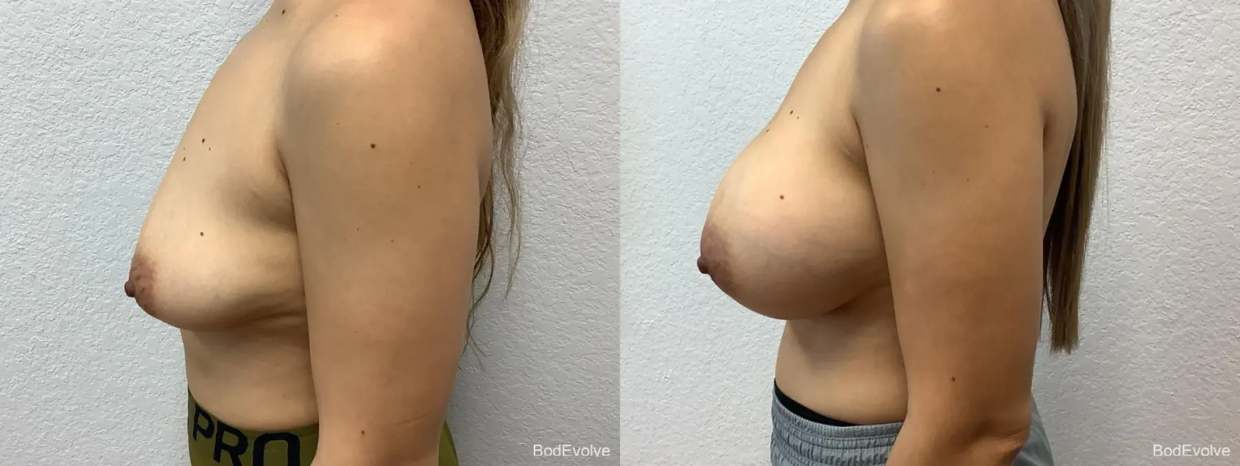 Breast Augmentation: Patient 5 - Before and After 3