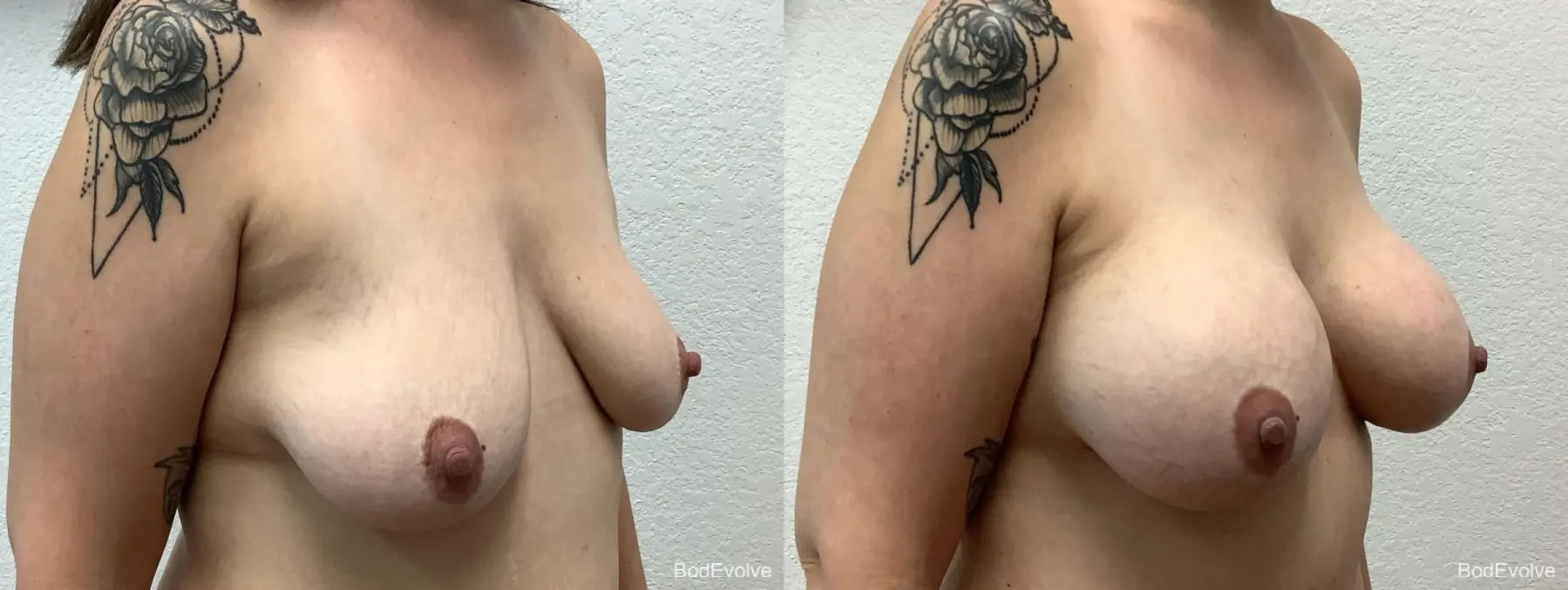 Breast Augmentation: Patient 8 - Before and After 4