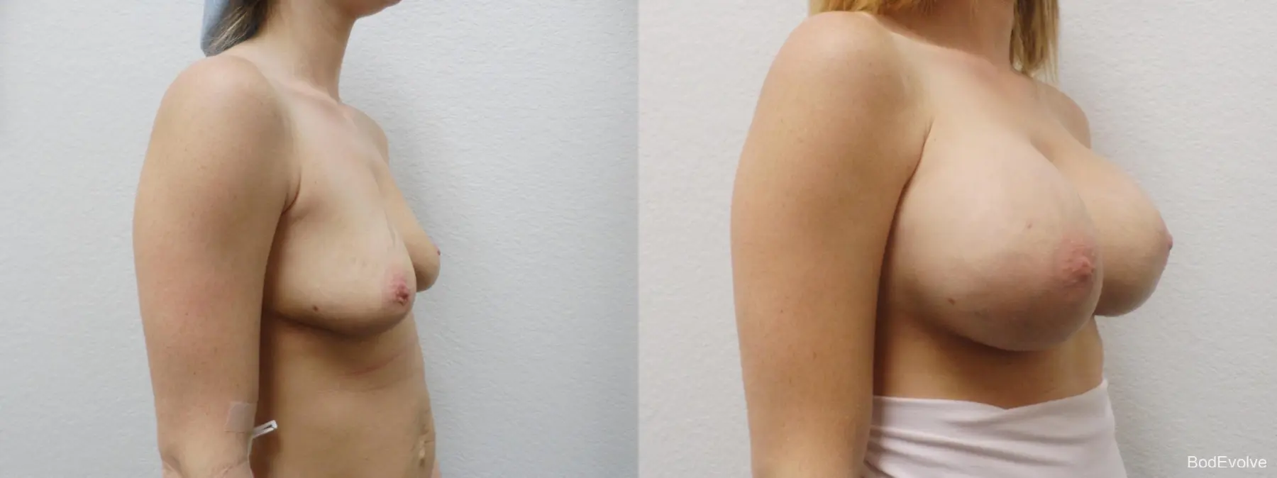 Breast Augmentation: Patient 3 - Before and After 4