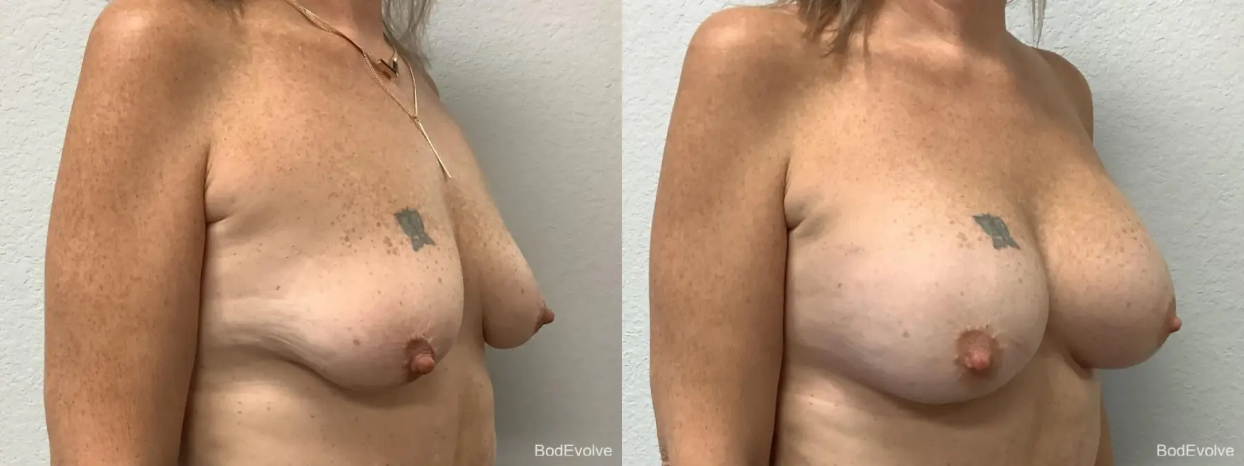 Breast Augmentation: Patient 9 - Before and After 4