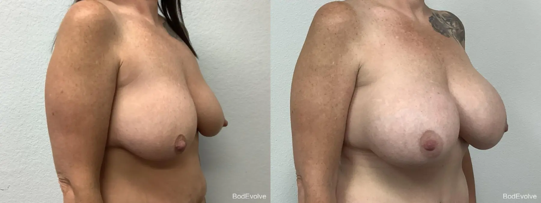 Breast Augmentation: Patient 4 - Before and After 4