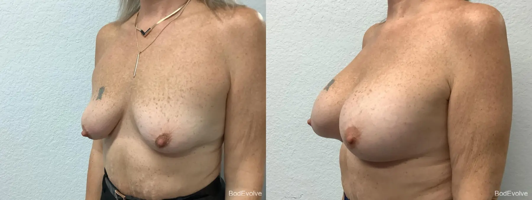 Breast Augmentation: Patient 9 - Before and After 2