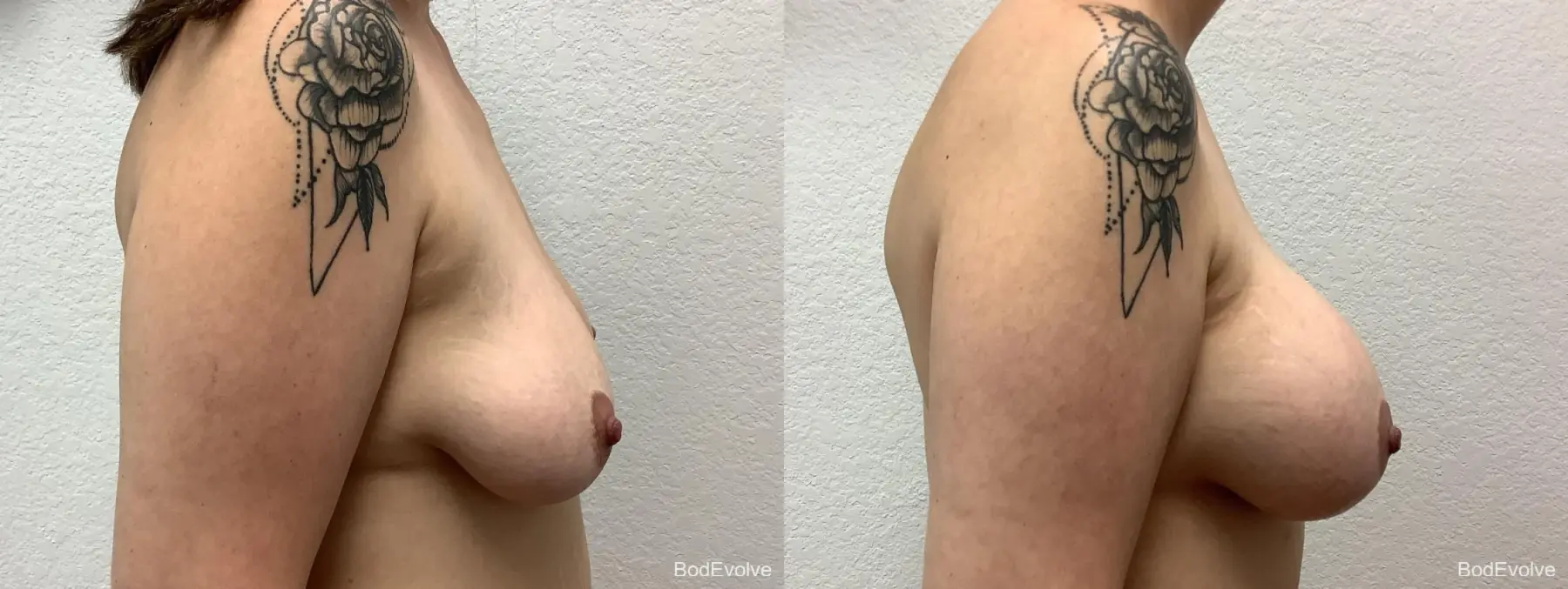 Breast Augmentation: Patient 8 - Before and After 5