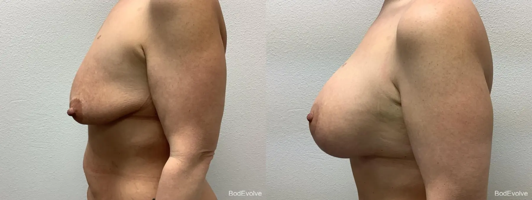 Breast Augmentation With Lift: Patient 1 - Before and After 3