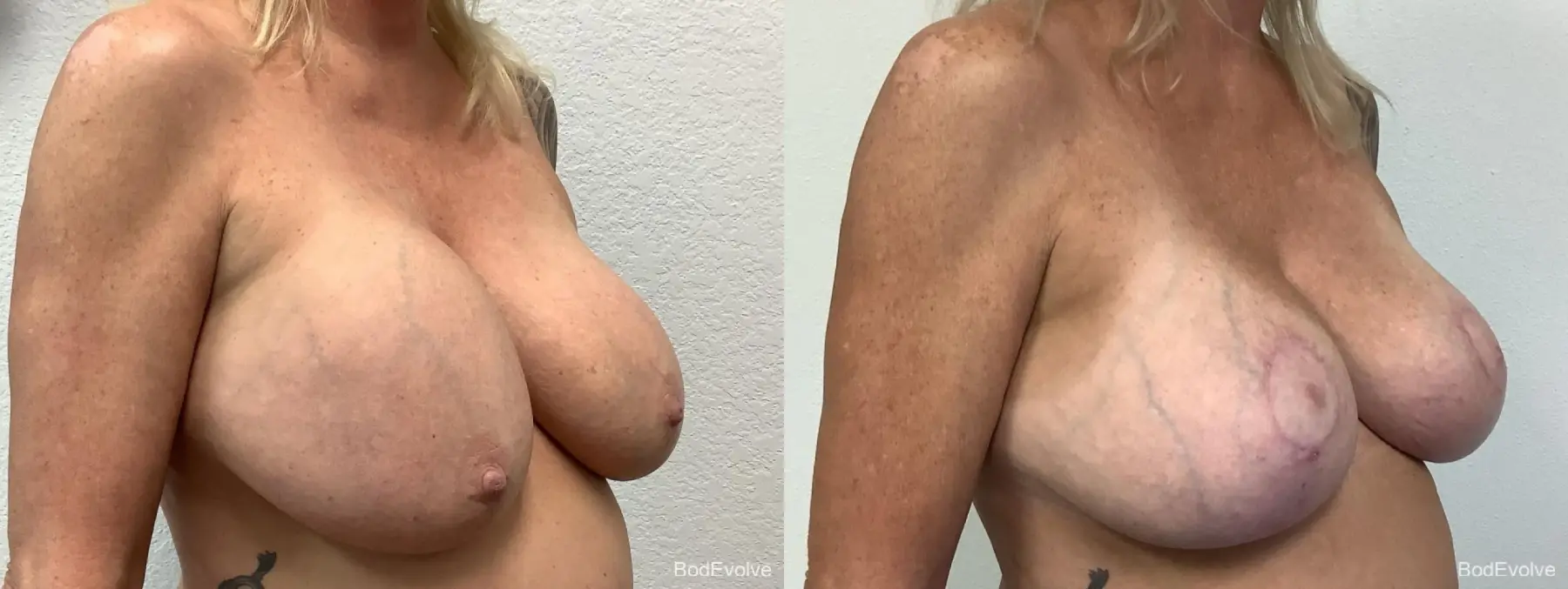 Breast Augmentation With Lift: Patient 3 - Before and After 4