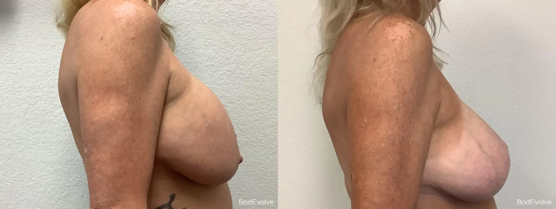 Breast Augmentation With Lift: Patient 3 - Before and After 5