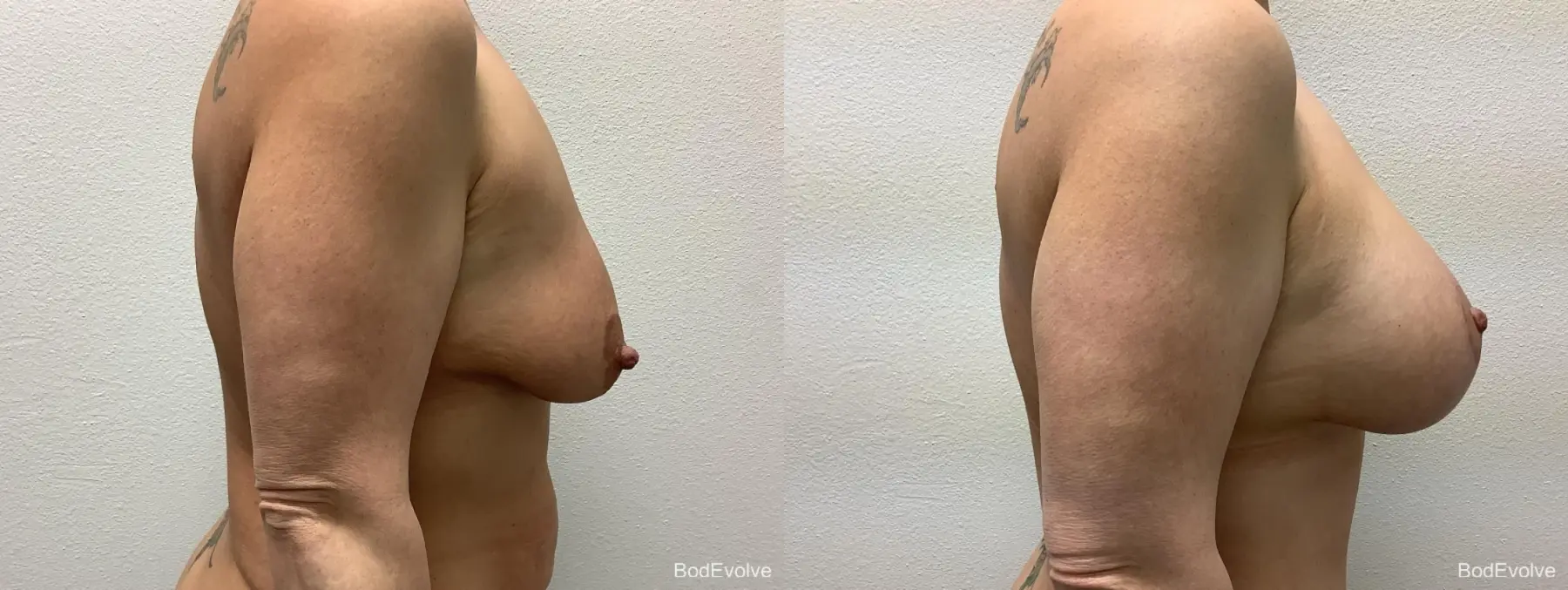 Breast Augmentation With Lift: Patient 1 - Before and After 5