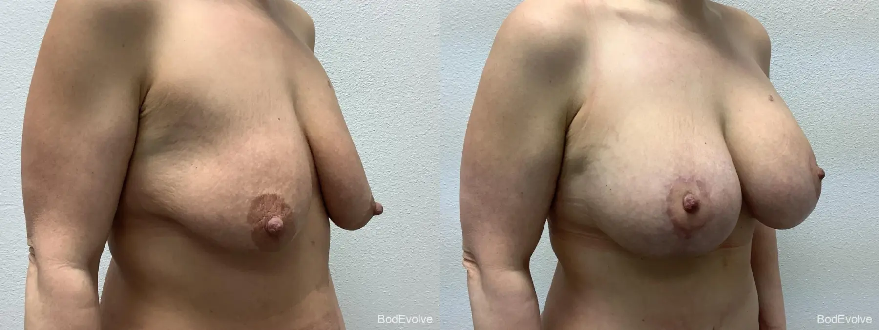 Breast Augmentation With Lift: Patient 1 - Before and After 4