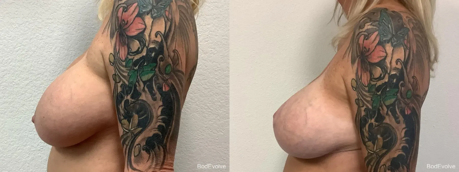 Breast Augmentation With Lift: Patient 3 - Before and After 3