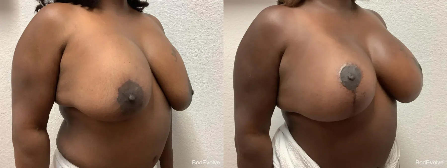 Breast Augmentation With Lift: Patient 2 - Before and After 5