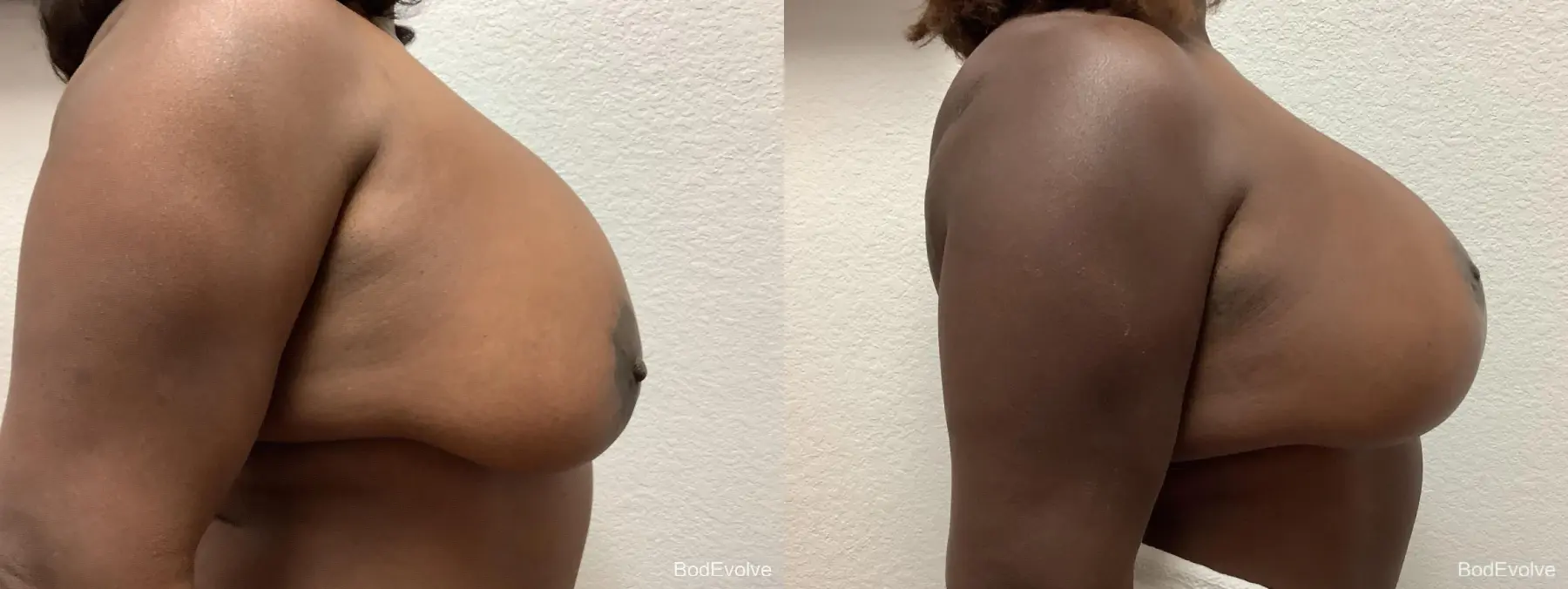 Breast Augmentation With Lift: Patient 2 - Before and After 4
