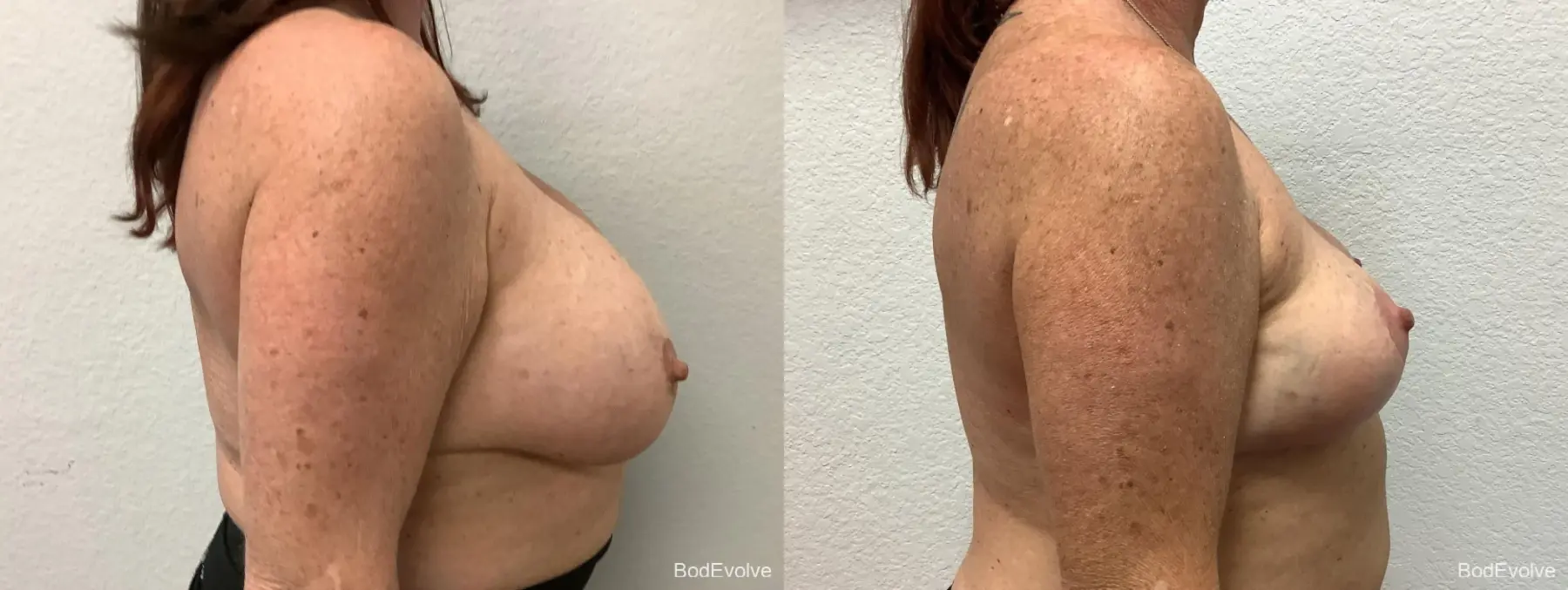 Breast Implant Removal With Lift: Patient 1 - Before and After 5