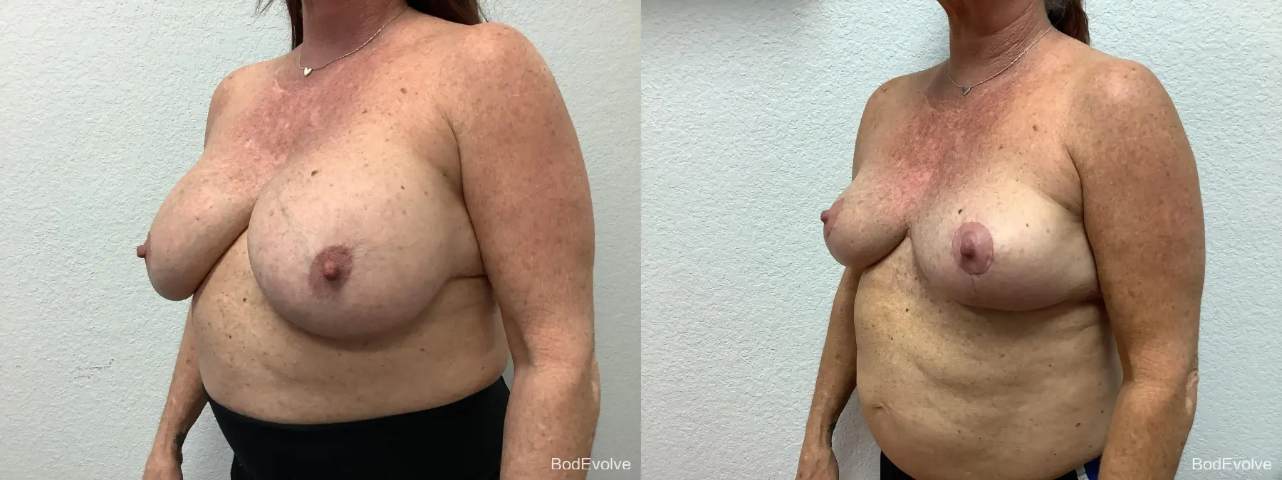 Breast Implant Removal With Lift: Patient 1 - Before and After 2