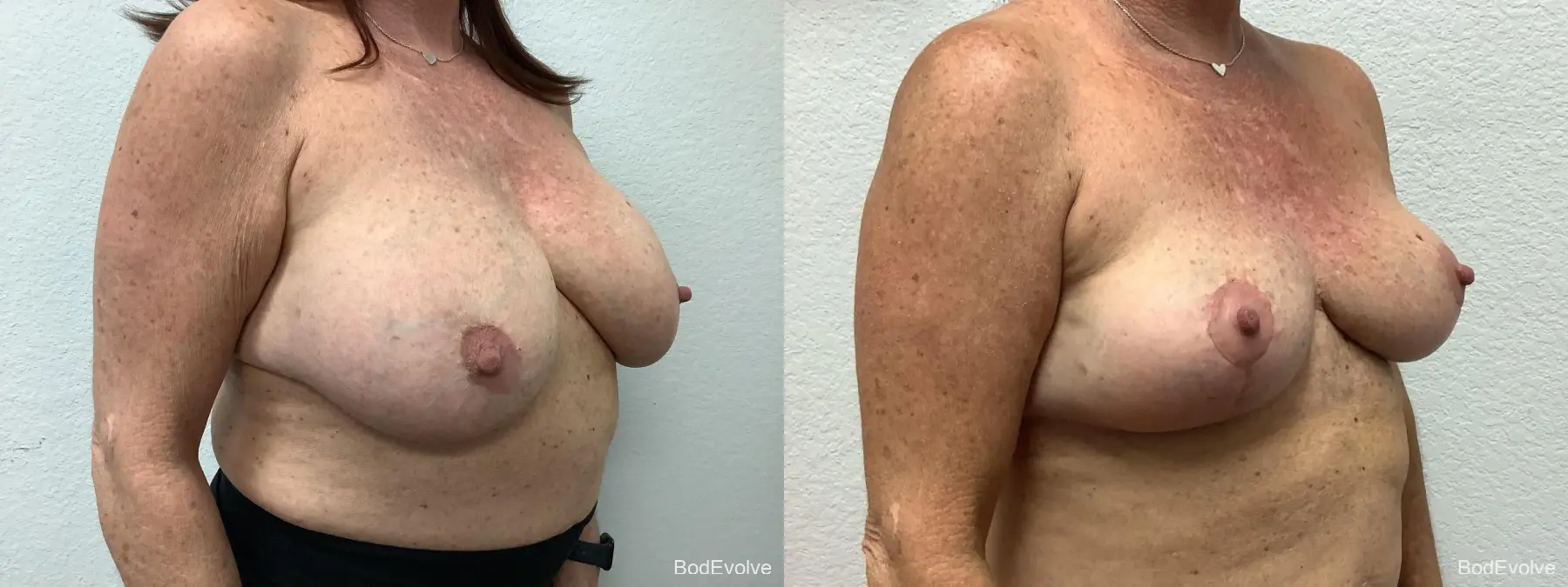 Breast Implant Removal With Lift: Patient 1 - Before and After 4