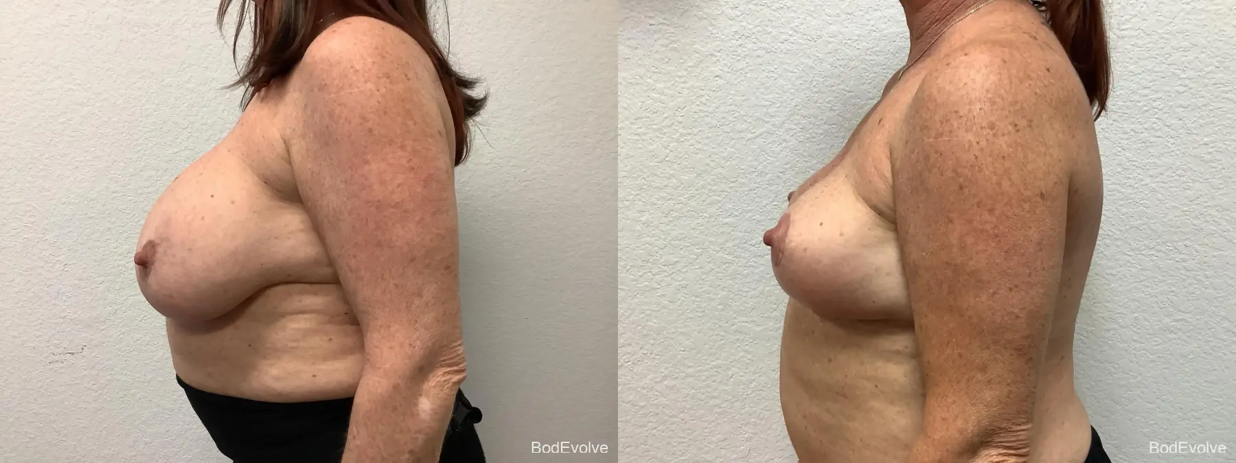 Breast Implant Removal With Lift: Patient 1 - Before and After 3