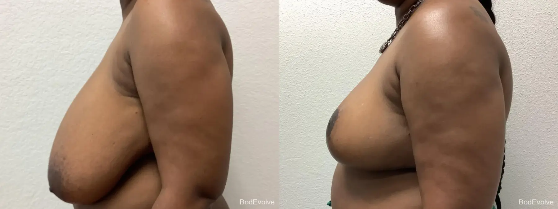 Breast Reduction: Patient 5 - Before and After 3