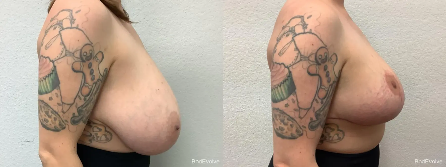 Breast Reduction: Patient 6 - Before and After 4